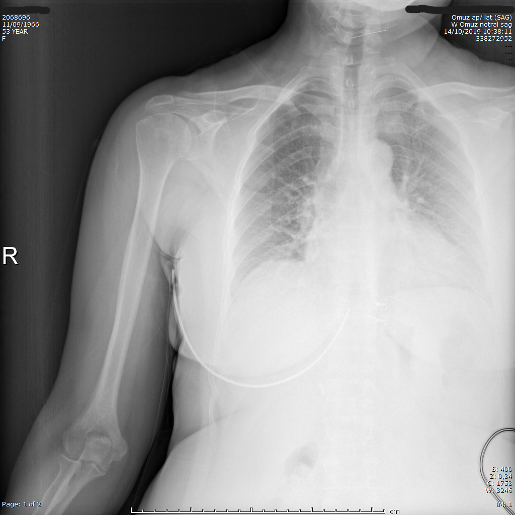 Preoperatif omuz röntgeni — daralmış AHD