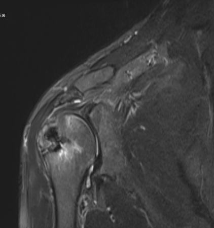 Postoperatif 3. ay MRI — tamir sonrası