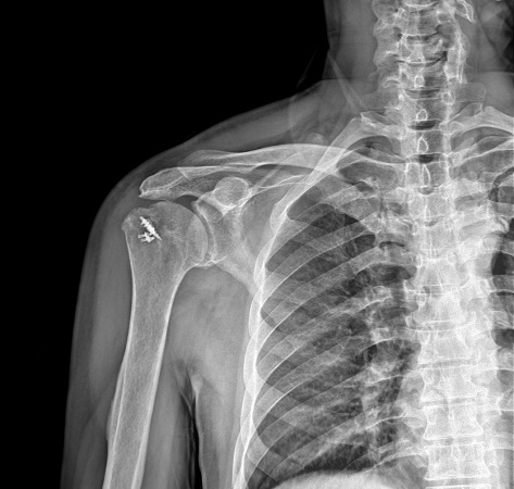 Postoperatif omuz röntgeni